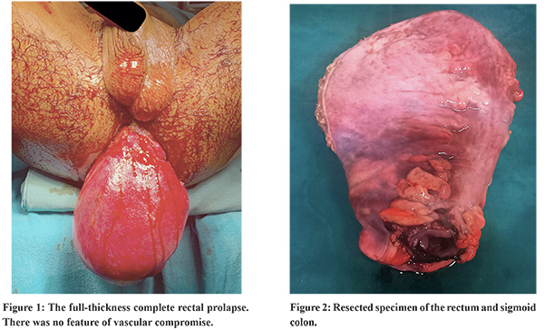 Irreducible Rectal Prolapse in a Patient with Anorectal